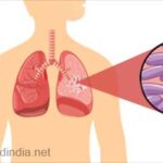 Know more about Tuberculosis and how to prevent