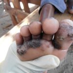 Musanze: Their behavior is that people suffering from Tungiasis are defiled by witchcraft