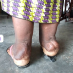 Parental involvement needed to eradicate Podoconiosis in Rwanda